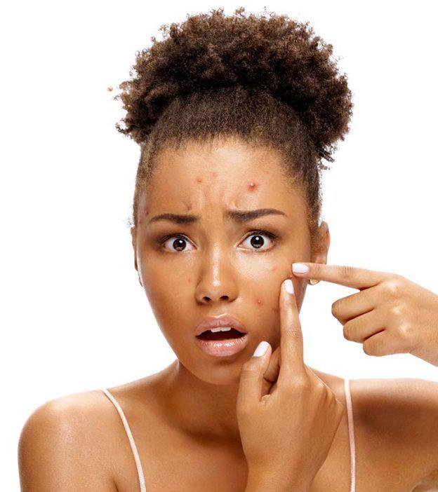 10 Biggest Skincare Mistakes That Are Causing Acne